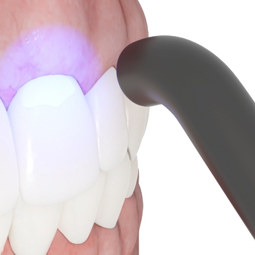 Illustrated ultraviolet light being shone on a tooth