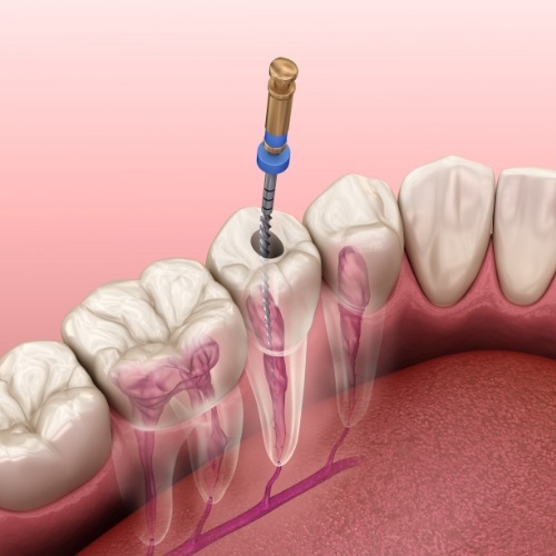 Illustrated dental instrument treating the inside of a tooth