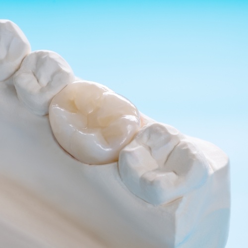 Dental crown covering a tooth in a model of the mouth