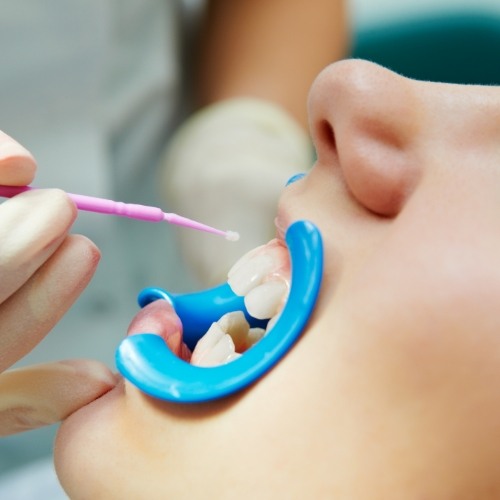 Close up of mouth being treated by dentist